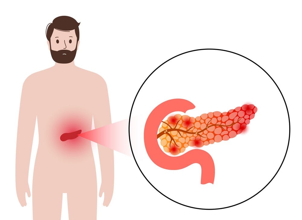 Chỉ số amylase là gì, có nghĩa lâm sàng như thế nào? 9 Chỉ số amylase là gì, có nghĩa lâm sàng như thế nào? 3